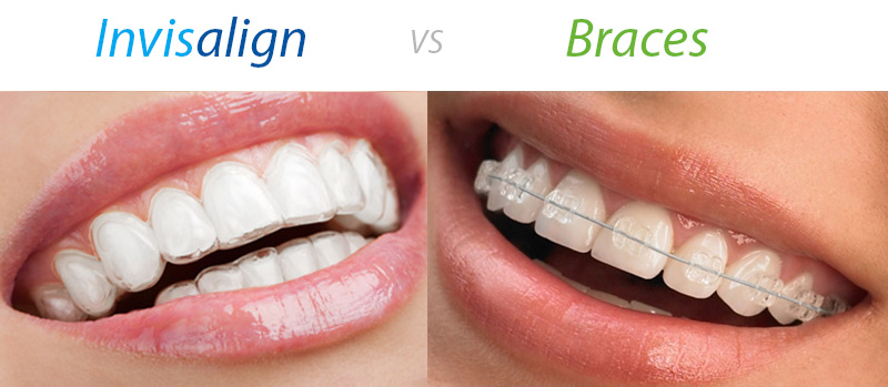 Braces or Invisalign: Which is Right for Me? 💎